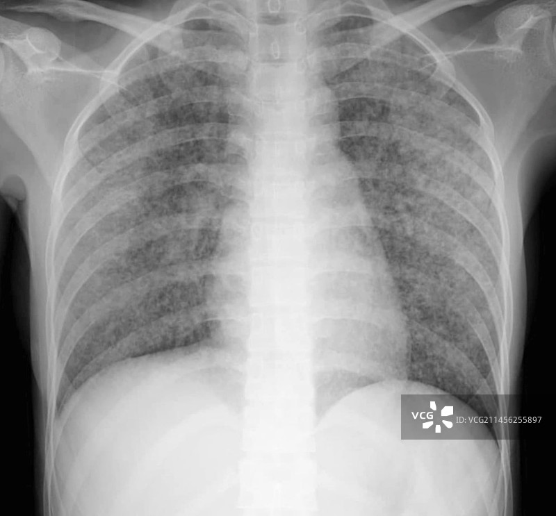 粟粒结节X光片图片素材