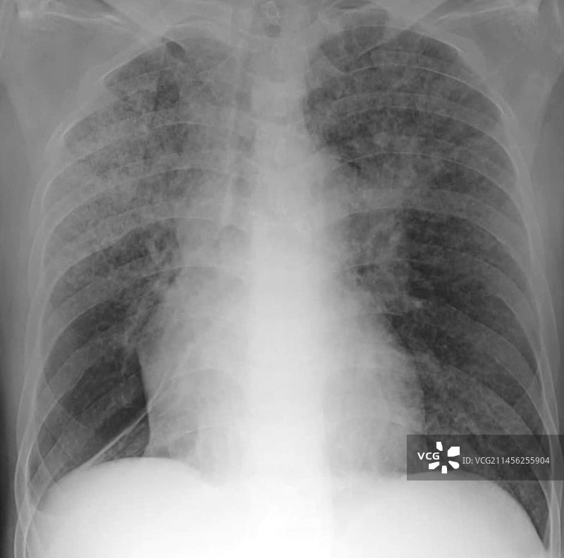 粟粒结节X光片图片素材
