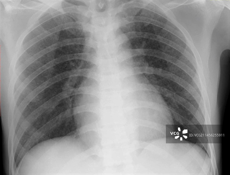 粟粒结节X光片图片素材