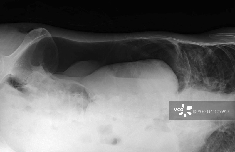 气腹X光片图片素材