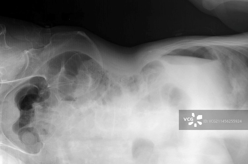 气腹X光片图片素材