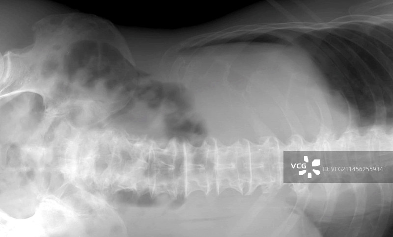 气腹X光片图片素材