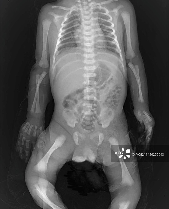 新生儿X光片图片素材