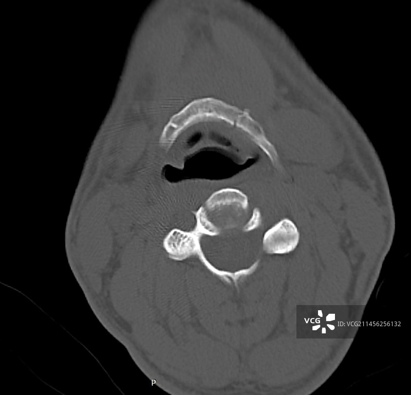 舌骨骨折CT扫描图片素材
