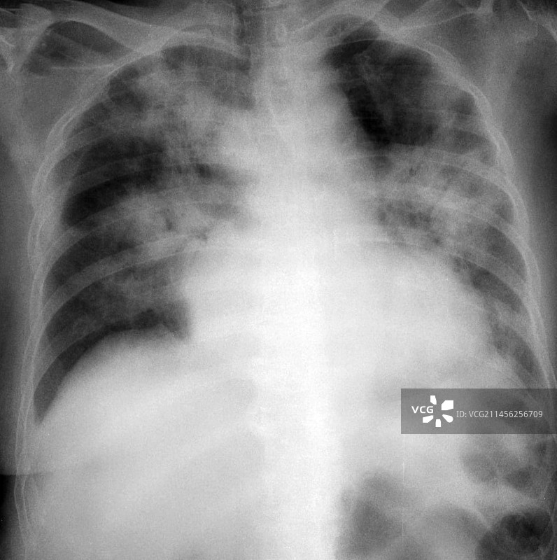 新冠肺炎胸部X光片图片素材