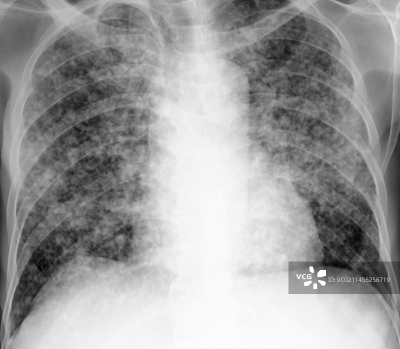 粟粒结节X光片图片素材