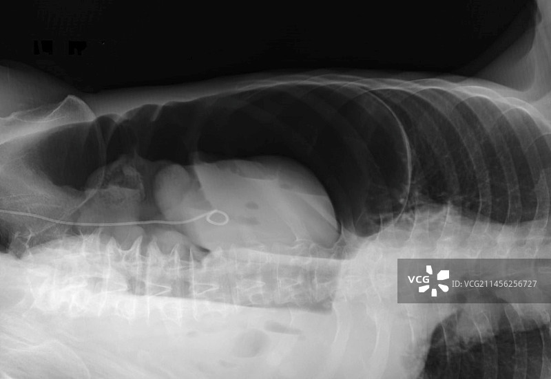 气腹X光片图片素材