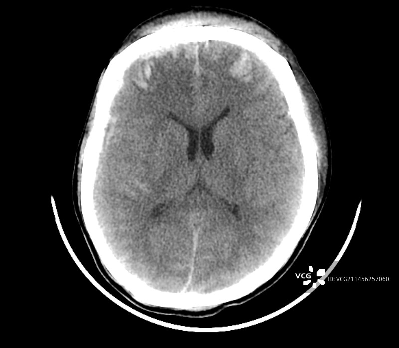 外伤性脑损伤CT扫描图片素材