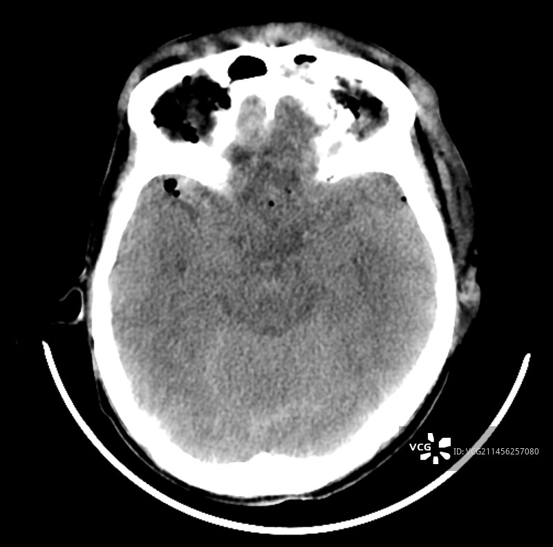 外伤性脑损伤CT扫描图片素材