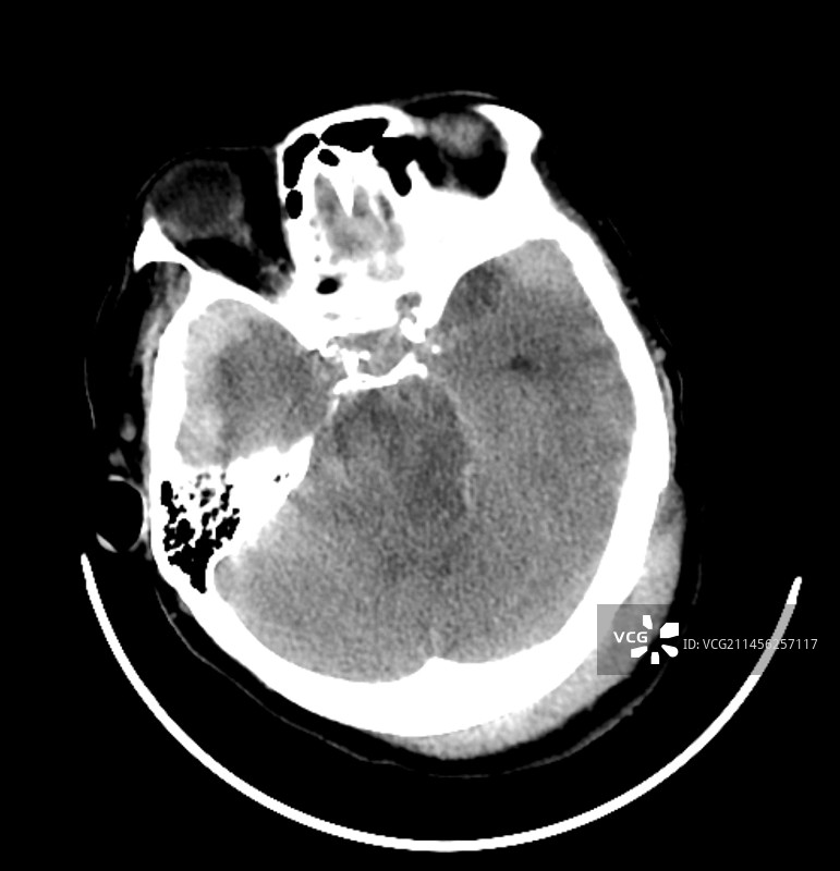 外伤性脑损伤CT扫描图片素材