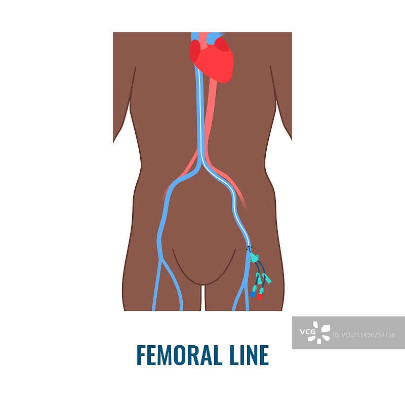 股静脉中心静脉导管插管图示图片素材