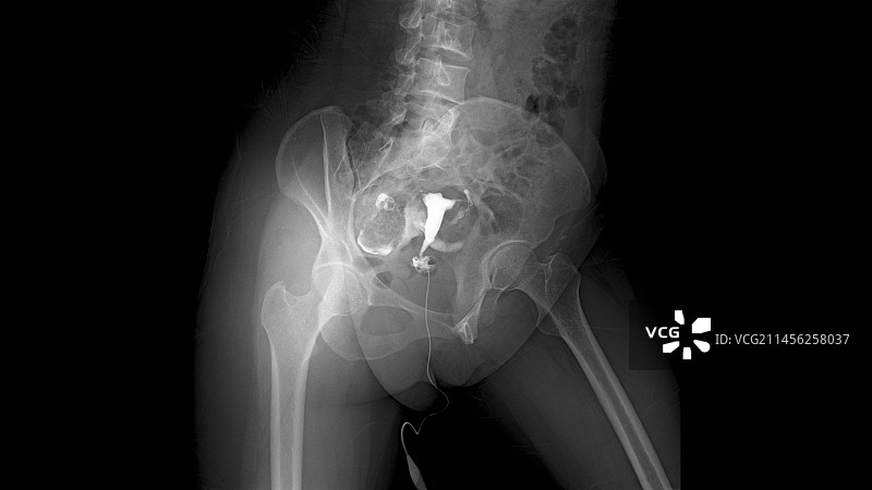 不孕症患者的输卵管X光片图片素材