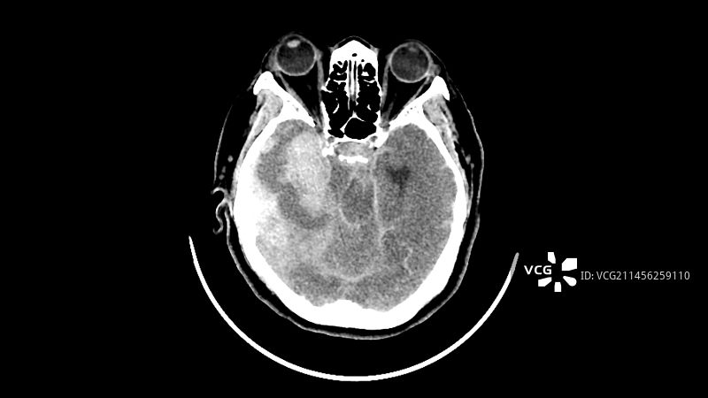 出血性中风CT扫描图片素材