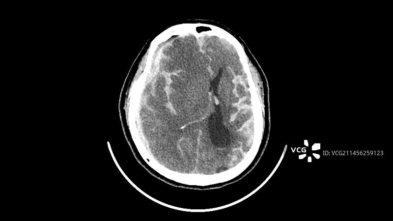 出血性中风CT扫描图片素材