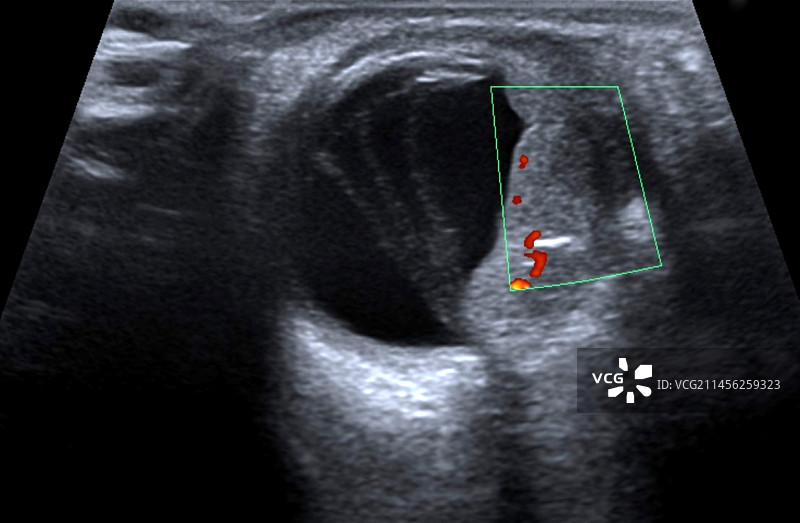 眼眶转移性肿瘤眼部超声扫描图片素材