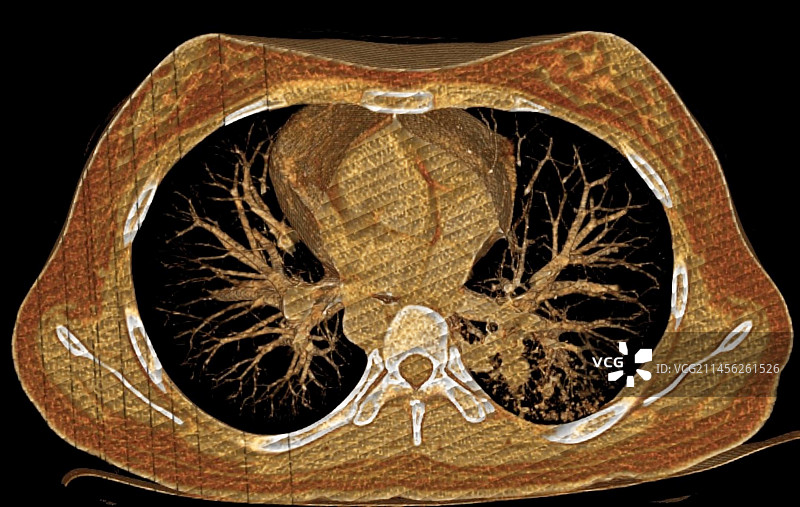 正常肺部CT扫描图片素材