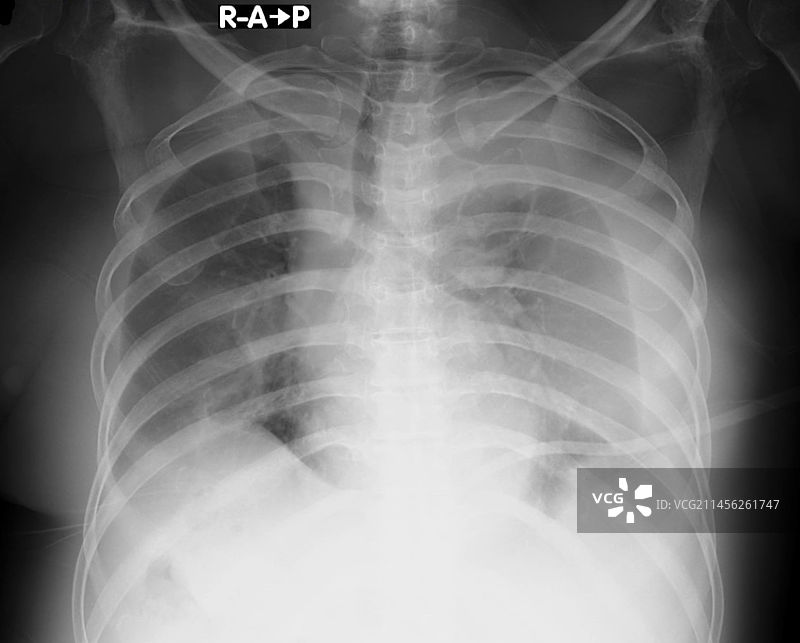 胸腔积液X光片图片素材