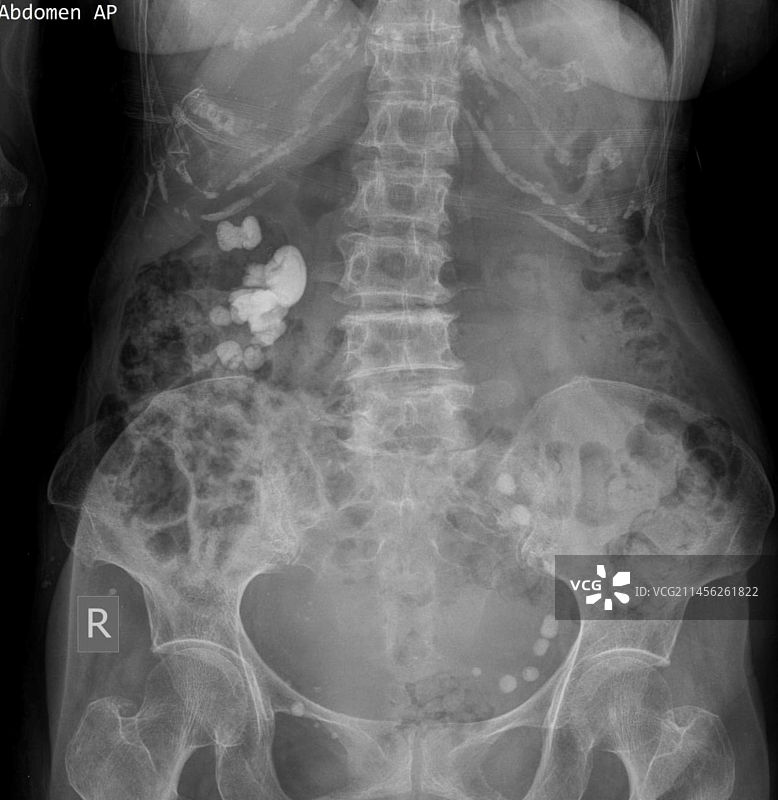 肾结石X光片图片素材