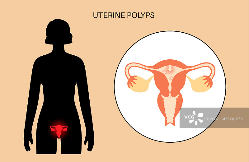 子宫息肉插图图片素材