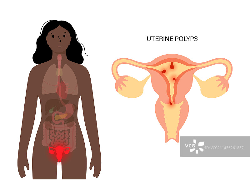 子宫息肉插图图片素材