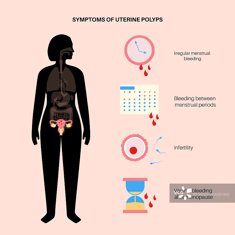 子宫息肉插图图片素材