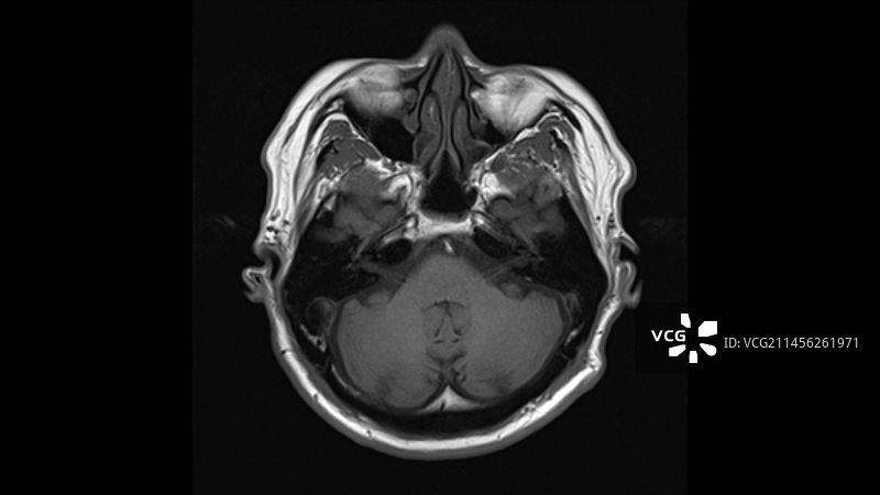 健康的大脑核磁共振扫描图片素材
