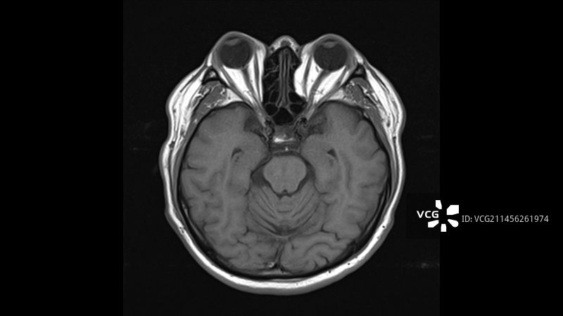 健康的大脑核磁共振扫描图片素材