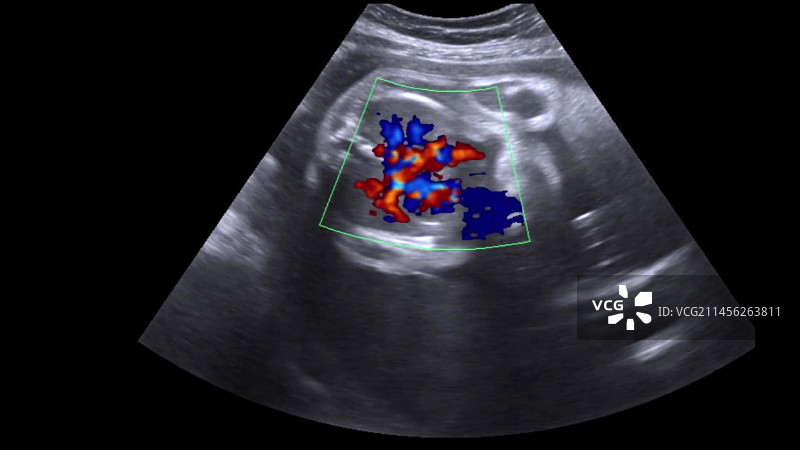胎儿心脏超声波扫描图片素材