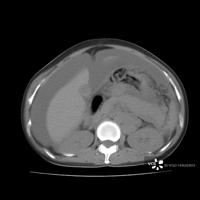 腹水CT扫描图片素材