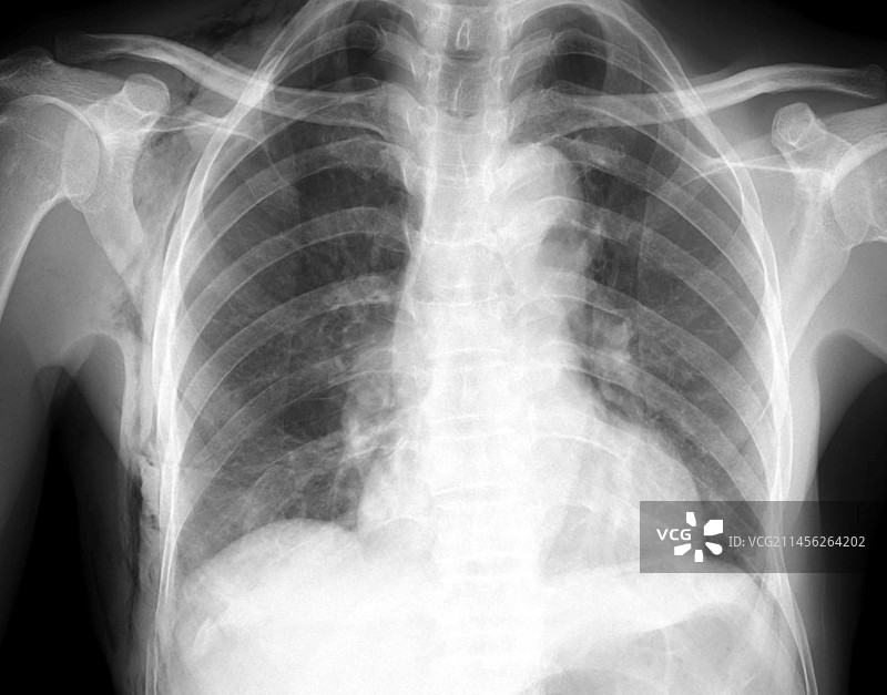 皮下气肿X光片图片素材