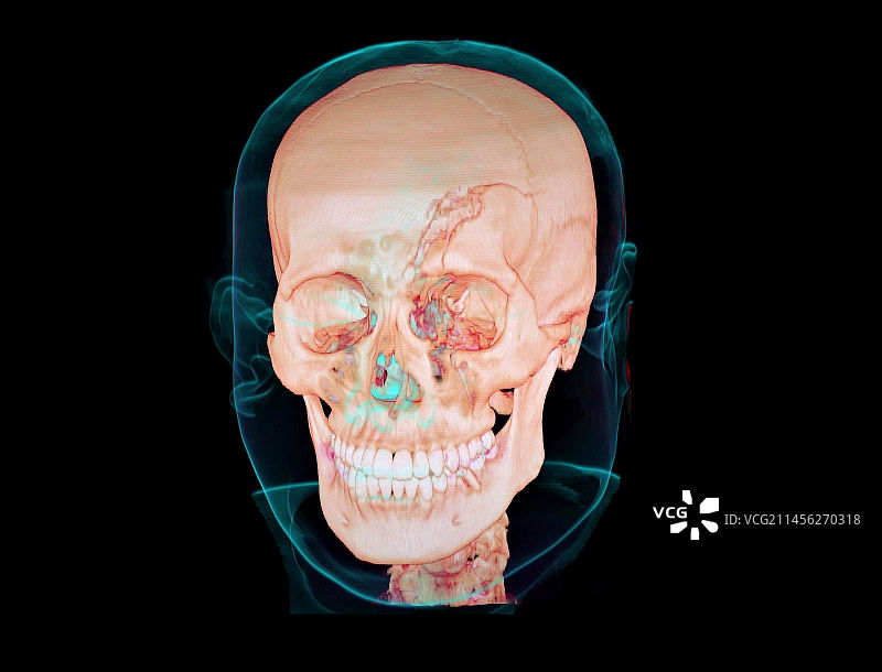颅骨骨折3D CT扫描图片素材