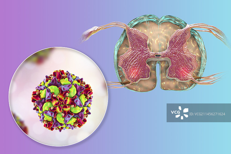 影响运动神经元的脊髓灰质炎病毒图片素材