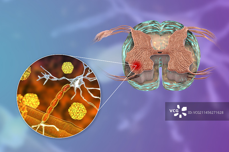 影响运动神经元的脊髓灰质炎病毒图片素材