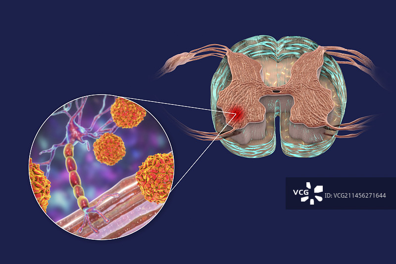影响运动神经元的脊髓灰质炎病毒图片素材