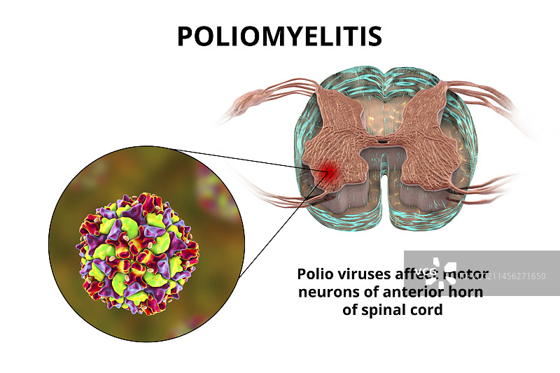 影响运动神经元的脊髓灰质炎病毒图片素材