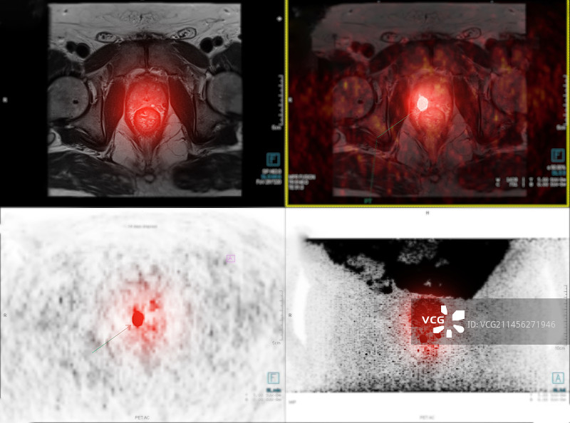 前列腺癌，PET和MRI扫描图片素材