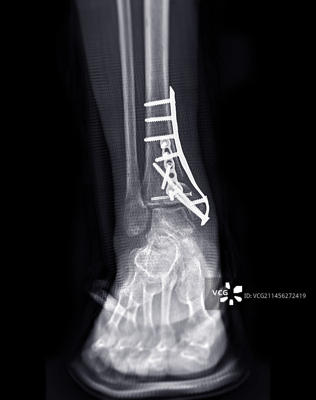 固定的骨折脚踝X光片图片素材