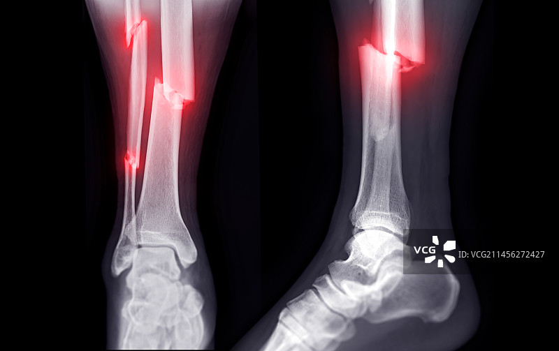 骨折X光片图片素材