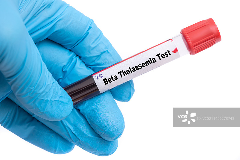 β地中海贫血测试概念图图片素材