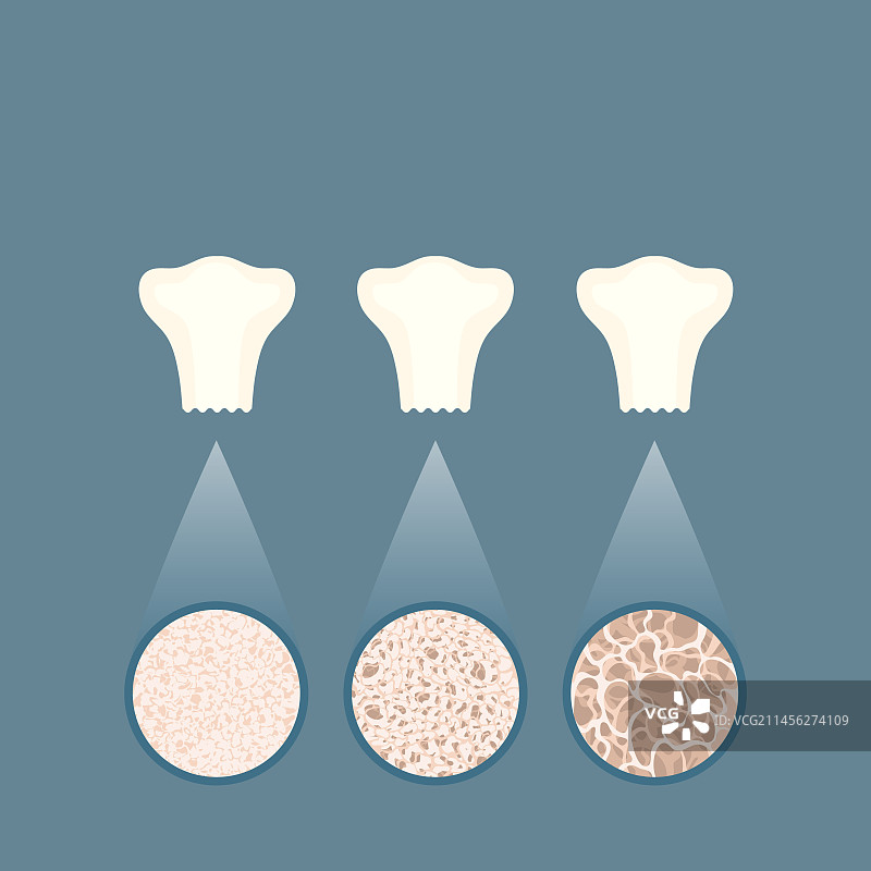 骨质疏松症概念图图片素材
