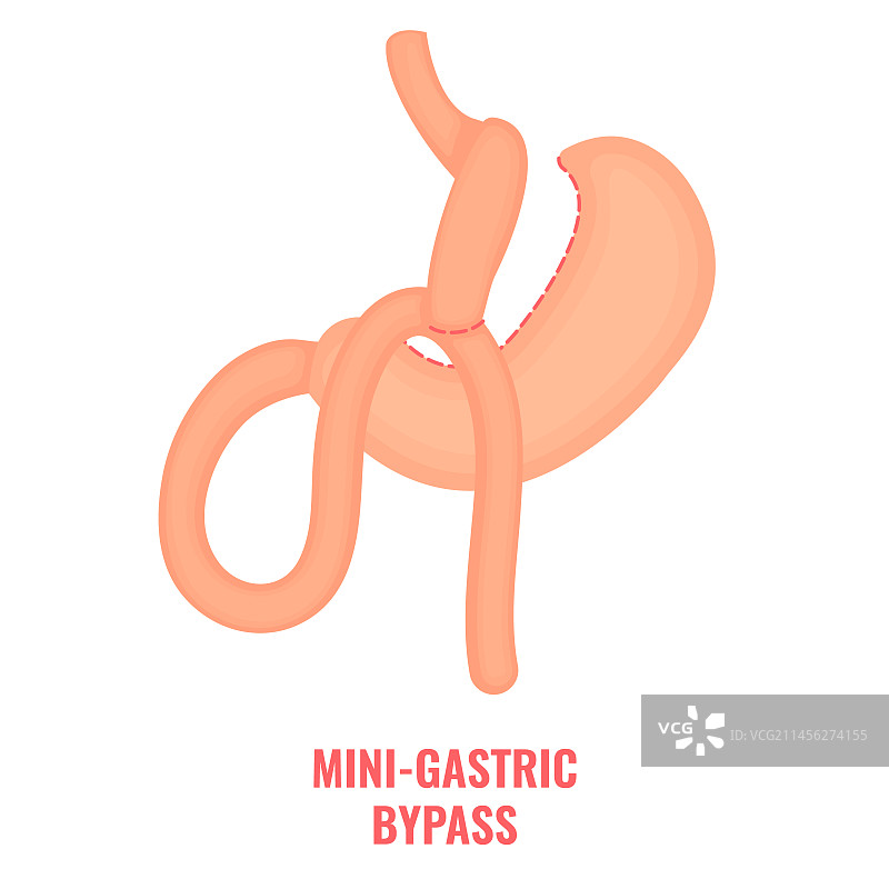 迷你胃旁路减肥手术图示图片素材