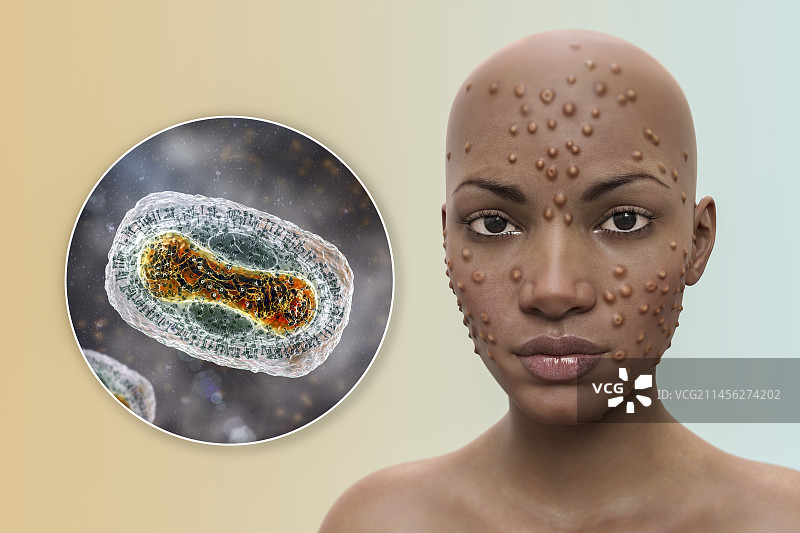 猴痘感染插图图片素材