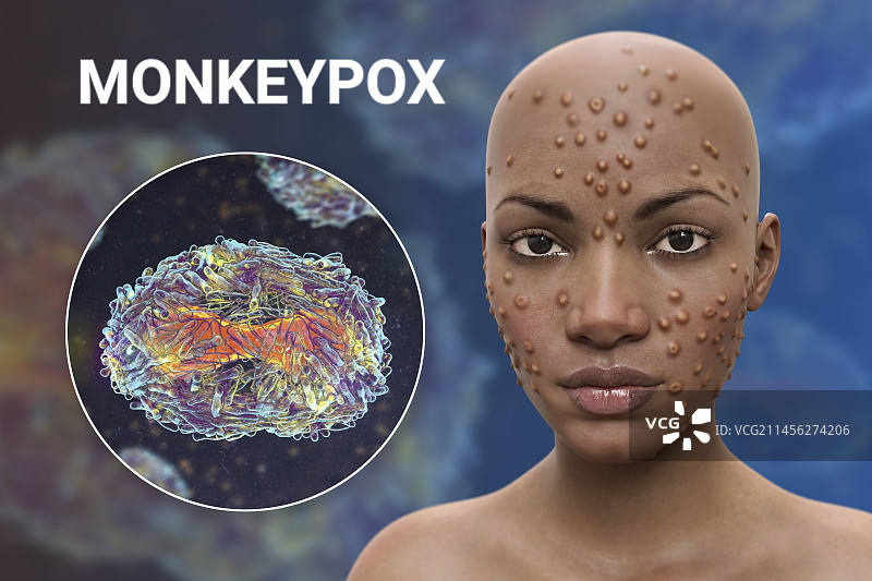 猴痘感染插图图片素材
