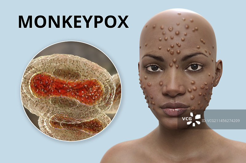 猴痘感染插图图片素材