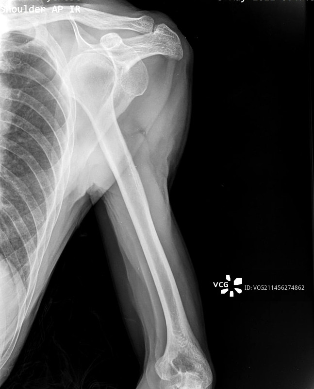 肩关节脱位X光片图片素材