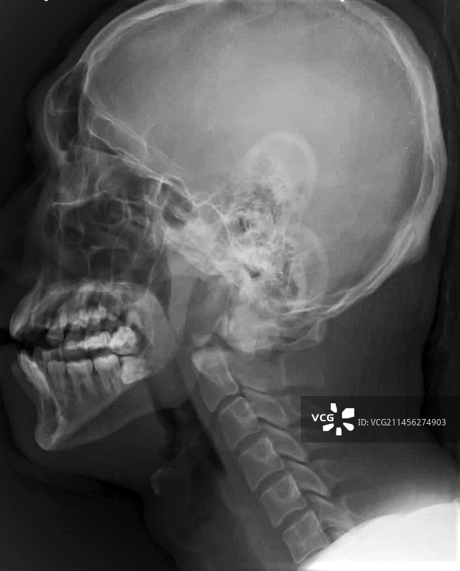 颈椎脱位X光片图片素材