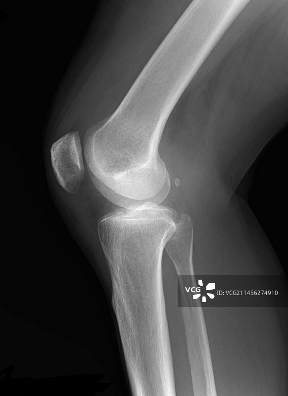 小骨X光片图片素材