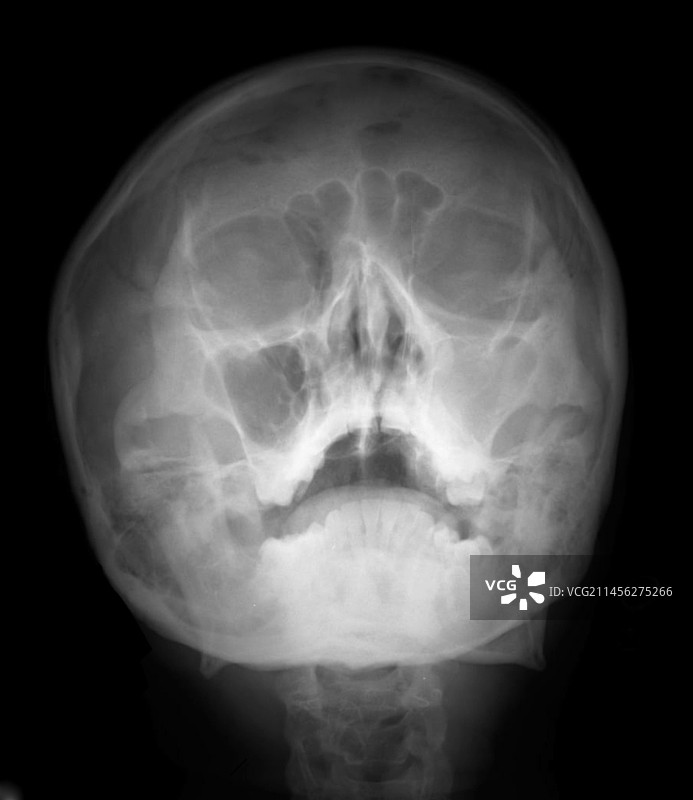 鼻窦炎X光片图片素材