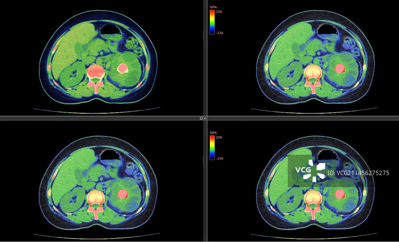 肾结石CT扫描图片素材