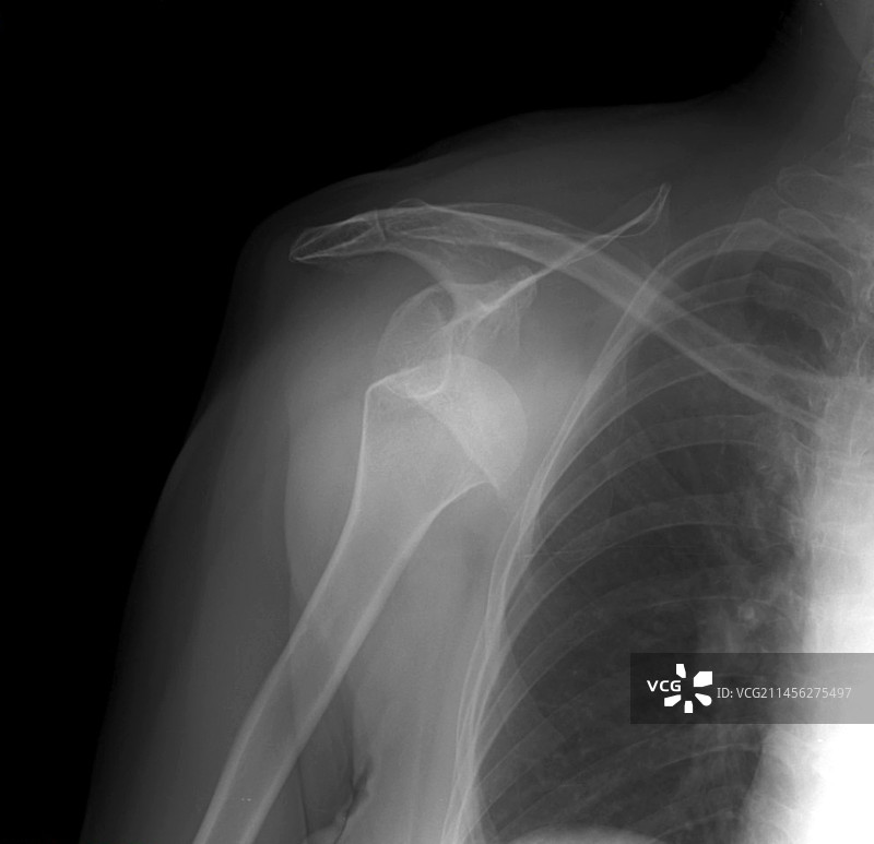 肩关节脱位X光片图片素材